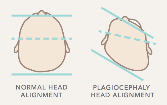 plagiocephaly